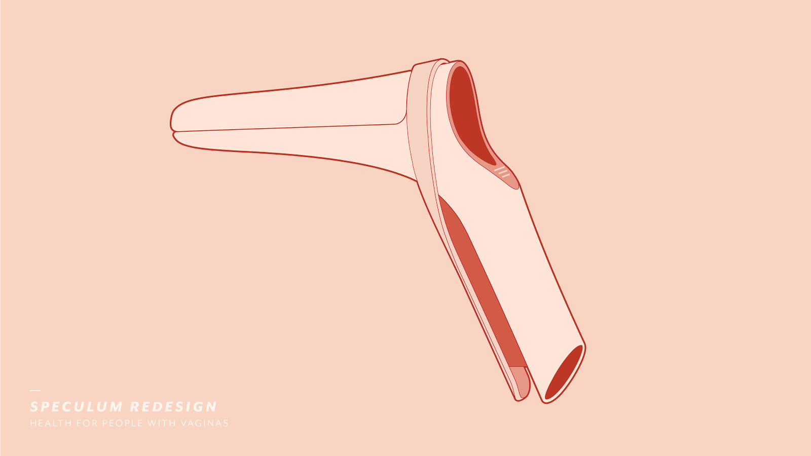 Redizajnirale vaginalni spekulum za ugodniji ginekološki pregled
